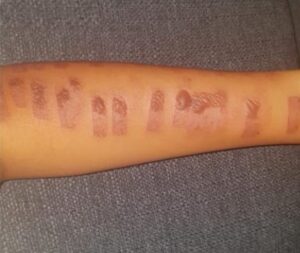 verbrennungen 2 ipl susanne kauen 768x648 1