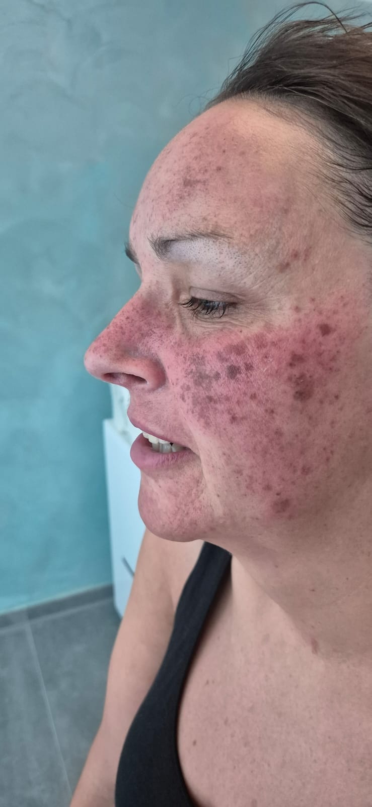 Nach der Behandlung Seitenansicht