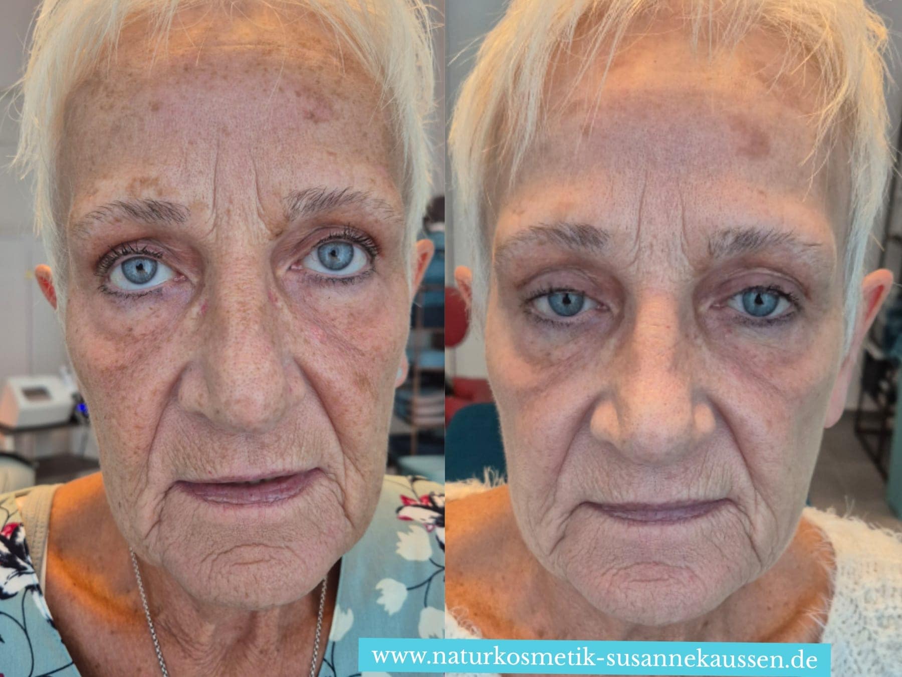 Photoverjüngung vorher nacher Seitenansicht