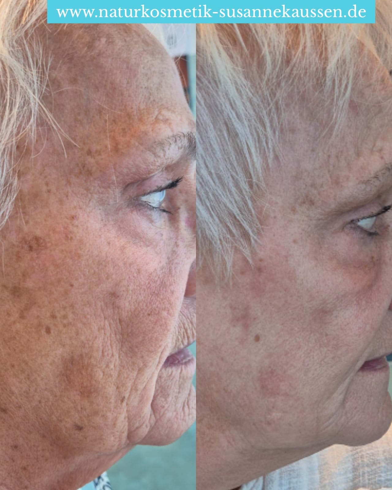 Photoverjuengung vorher nacher Seitenansicht