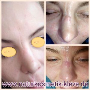Mezotix Behandlungserfolg Vorher Nachher Bilder Naturkosmetik Susanne Kaußen Kosmetikerin Bedburg-Hau