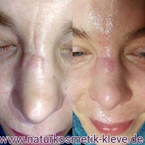 Behandlungserfolge bei der Narbenbehandlung mit Mezotix Susanne Kaußen Naturkosmetik Susanne Kaußen (vormals Naturkosmetik Kleve)